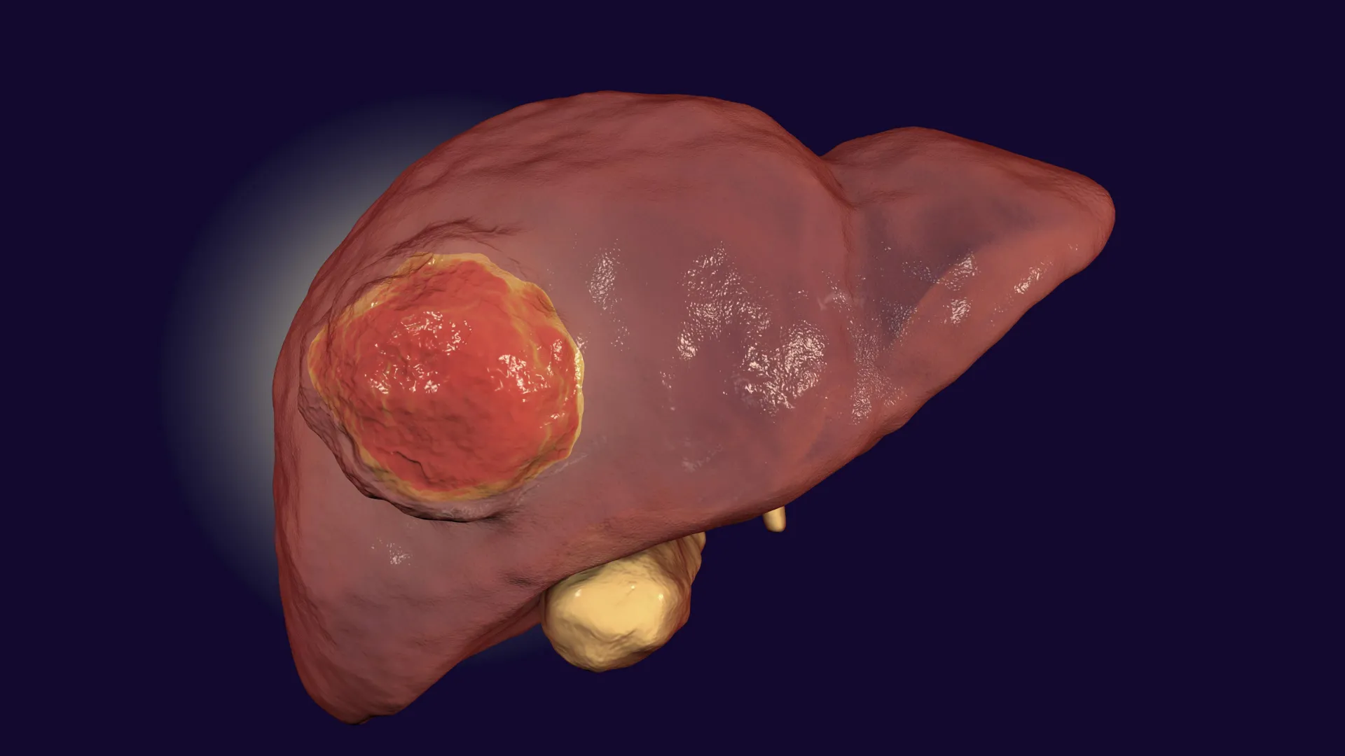 FDA-approved drug may finally help immunotherapy defeat rare liver cancer